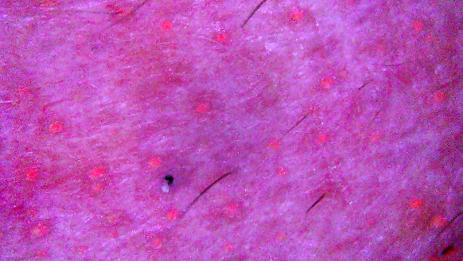 Tricoscopia — presença de bactérias