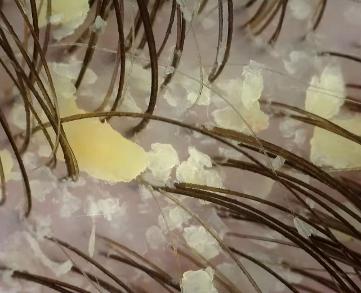 Tricoscopia — dermatite