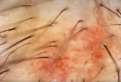 Tricoscopia — inflamação oculta