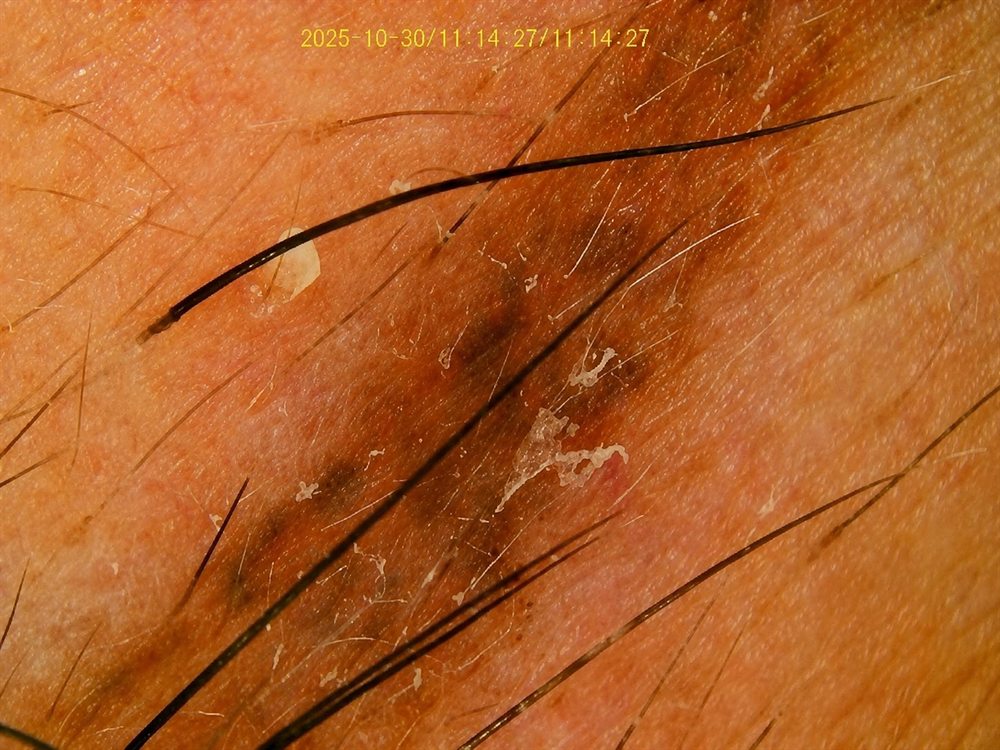 Tricoscopia — pigmento residual e discromia de pele
